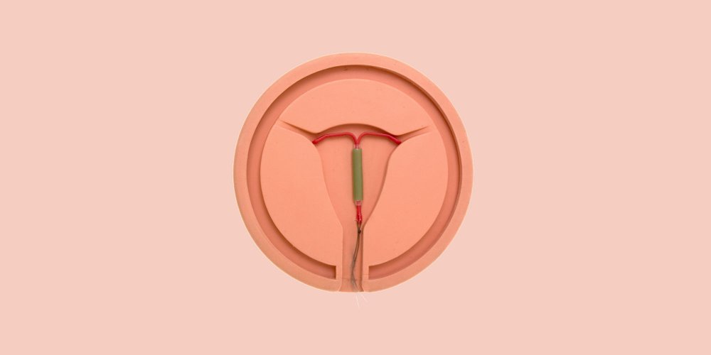 Stérilet Mirena : un contraceptif au coeur d'une polémique ...