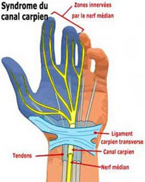 Syndrome du canal carpien. Symptômes et Diagnostics. II