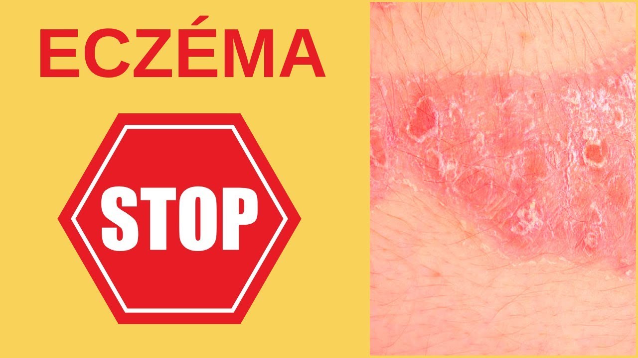 Huile essentielle eczema : Mes solutions ! | Huiles ...