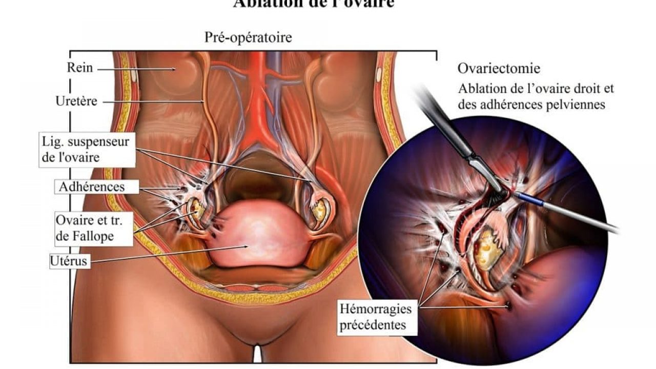 Douleur aux ovaires après les règles: que faut-il faire ...